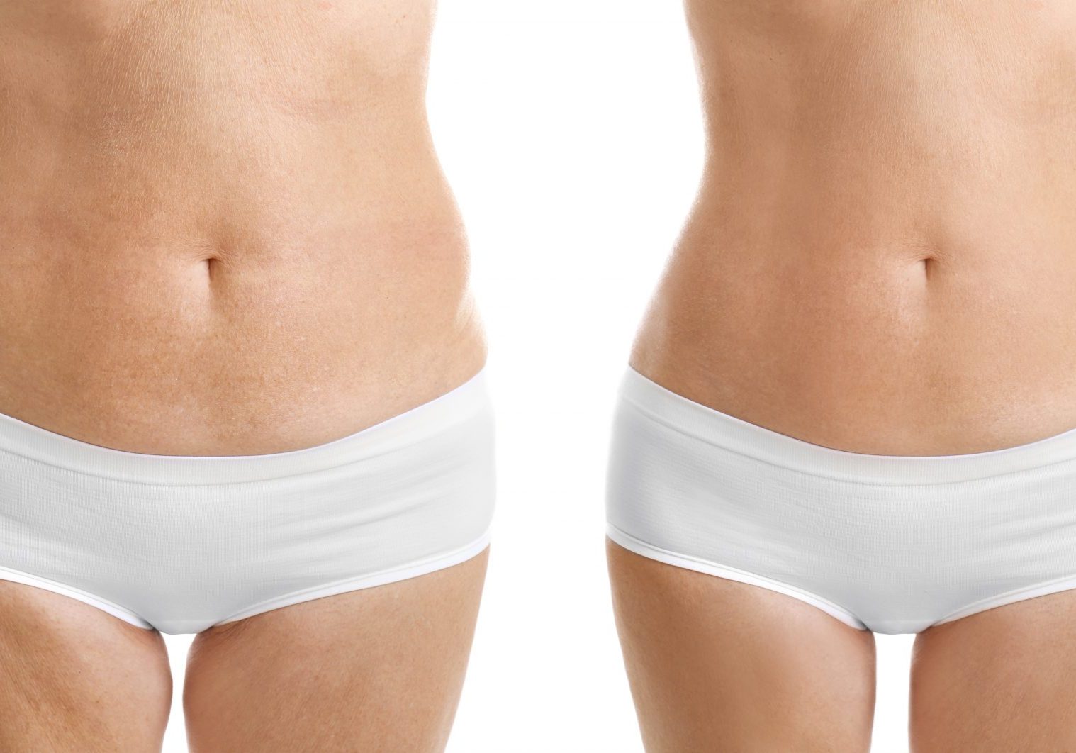 Mesoterapia reductora